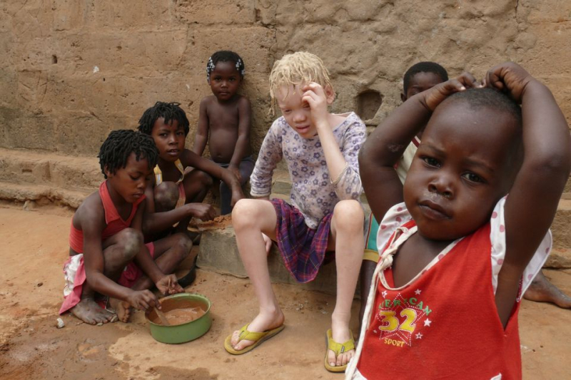 172391-les-enfants-albinos-sont-les-plus-exposes-aux-accusations-avec-les-orphelins-et-les-enfants-handicap